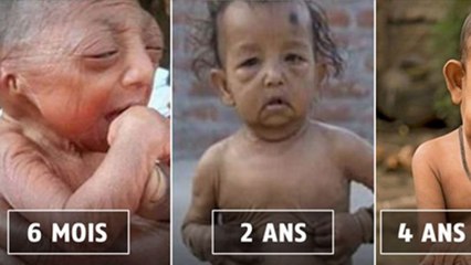 Atteint de progeria, Bayezid Hossain est surnommé le "Benjamin Button du Bangladesh"