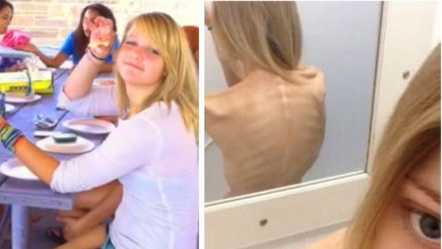 Sie begann mit einer einfachen Diät. Doch ihre Geschichte nimmt ein tragisches Ende...