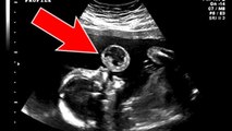 Der Ultraschall dieses Babys, das „eine Blase“ zu machen scheint, bringt eine schreckliche Wahrheit ans Licht