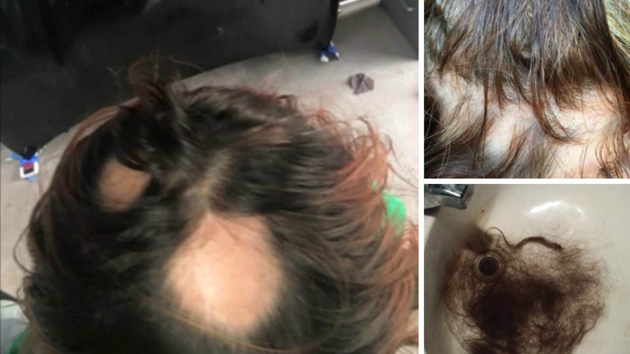 Ein ganz bestimmtes Shampoo soll für den Haarausfall zahlreicher Frauen verantwortlich sein