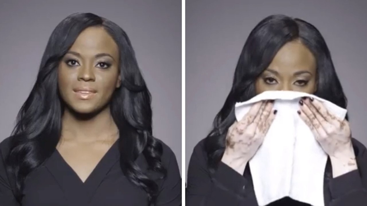 Diese junge Frau wirkt völlig normal, doch leidet an einer seltenen Hautkrankheit