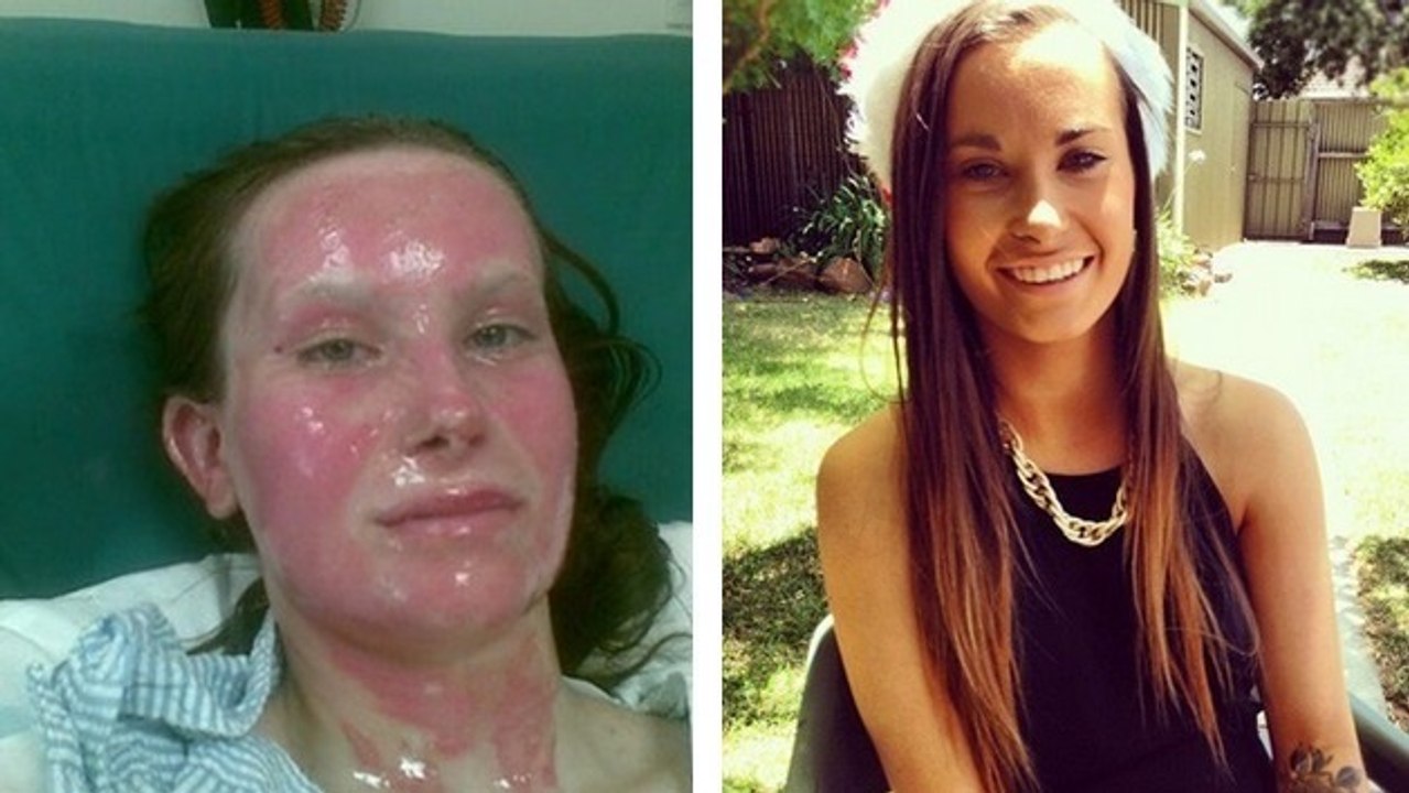 Mit schweren Verbrennungen im Gesicht meistert sie das Leben