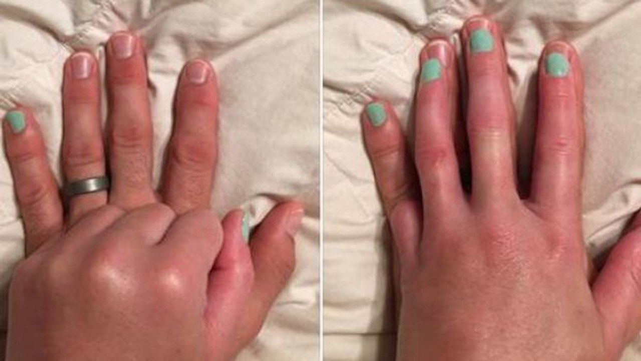 Die wundervolle geste eines mannes für seine frau, der ein finger amputiert wurde