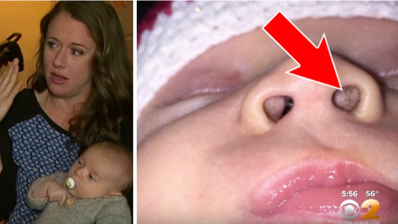 Die schwarzen Punkte in der Nase des Babys wurden von einem Produkt verursacht, dass viele benutzen