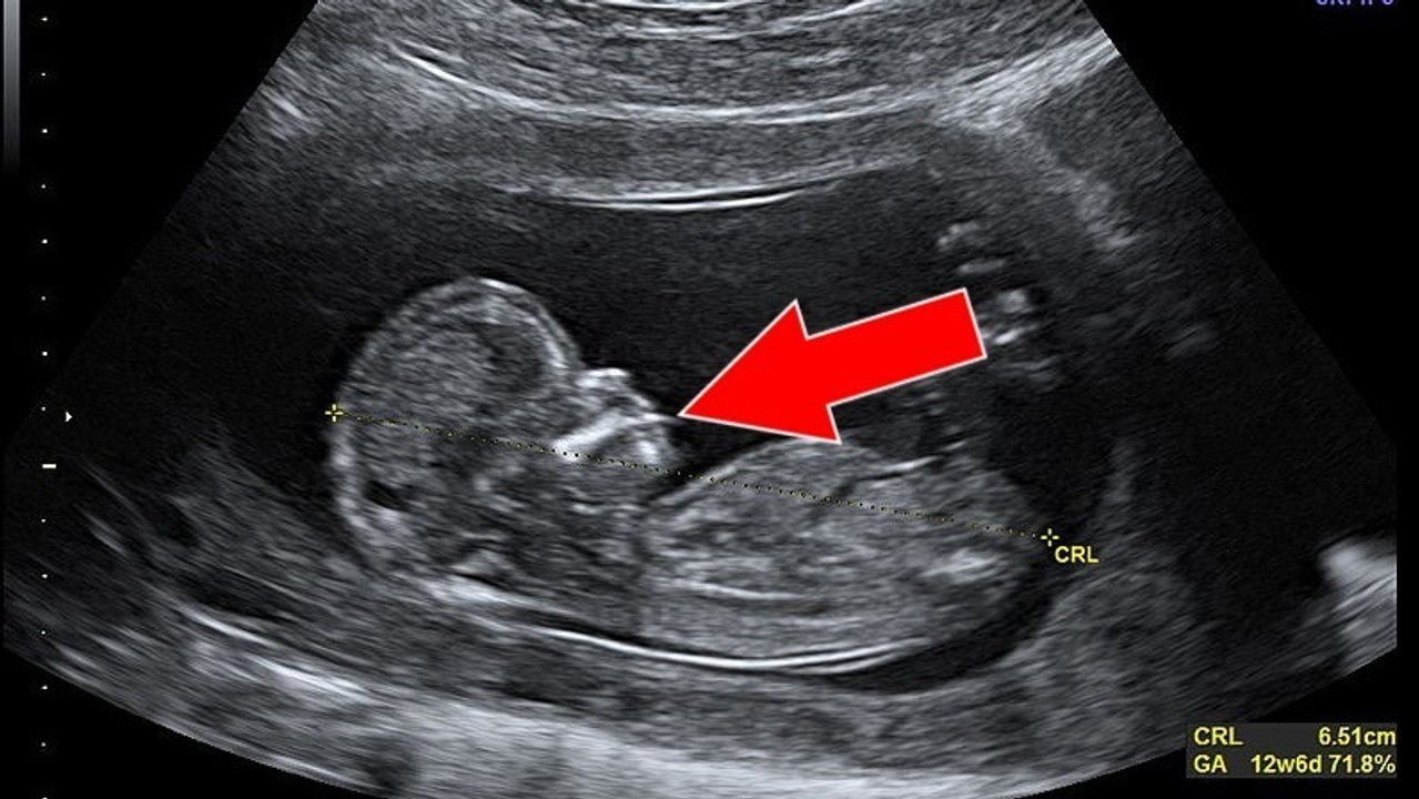Beim Ultraschall erfährt eine junge Amerikanerin, dass ihr Baby herzkrank ist.