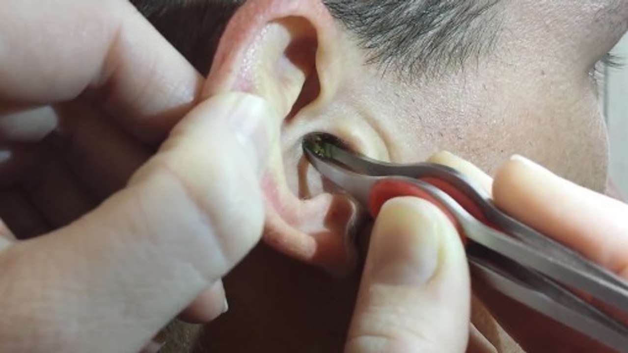 Pfropfen im Ohr: Mit welchen Mitteln du ihn entfernen kannst - und was du nicht tun solltest