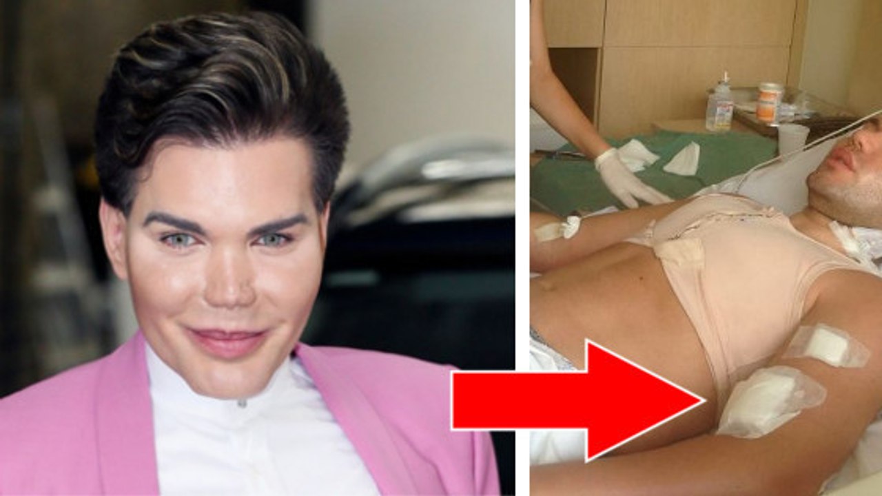 Rodrigo Alves: Nach 47 Operationen beginnt die Haut des „menschlichen Kens“ abzusterben