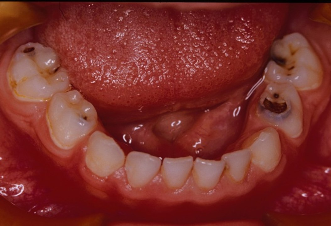 Xylit: Das neue Wundermittel gegen Karies