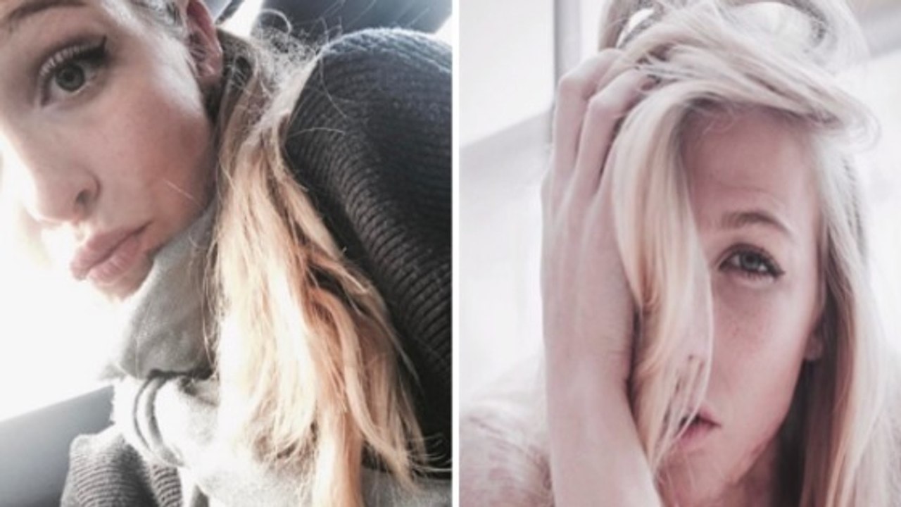 Diese junge Frau verbrannte durch einen Unfall an 40% ihres Körpers