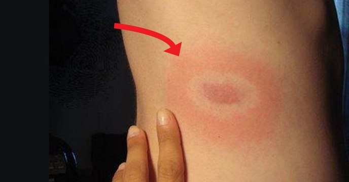 Zecken und Zeckenbisse: Darauf musst du achten!