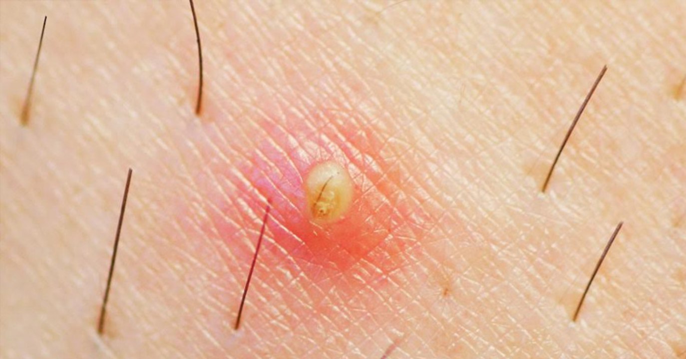 Eingewachsenes Haar mit Alaunstein entfernen Entzündung und Eiter vermeiden video