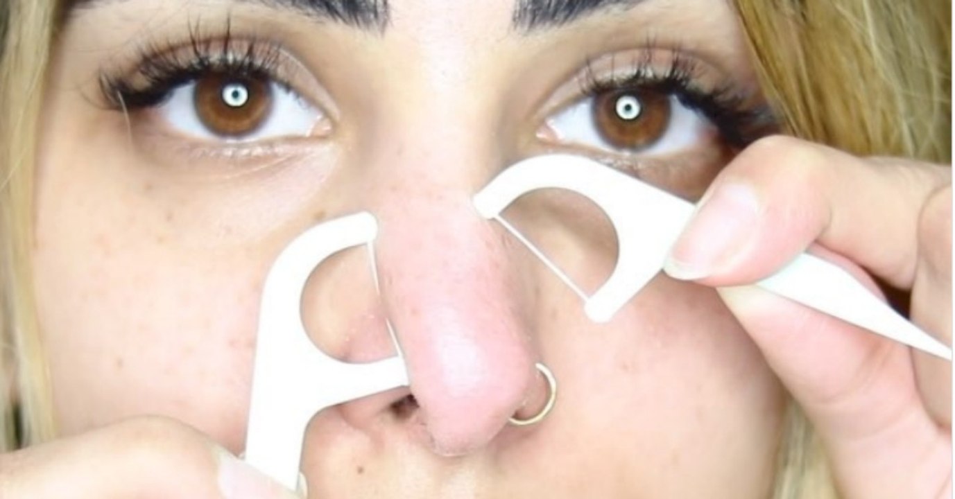 Sie will ihre Mitesser loswerden, doch ihre Methode ist ganz schön fragwürdig