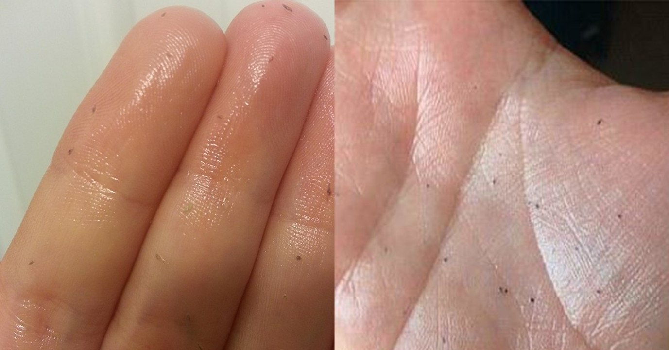 Skin Gritting: Der neue Beauty-Trend gegen Mitesser