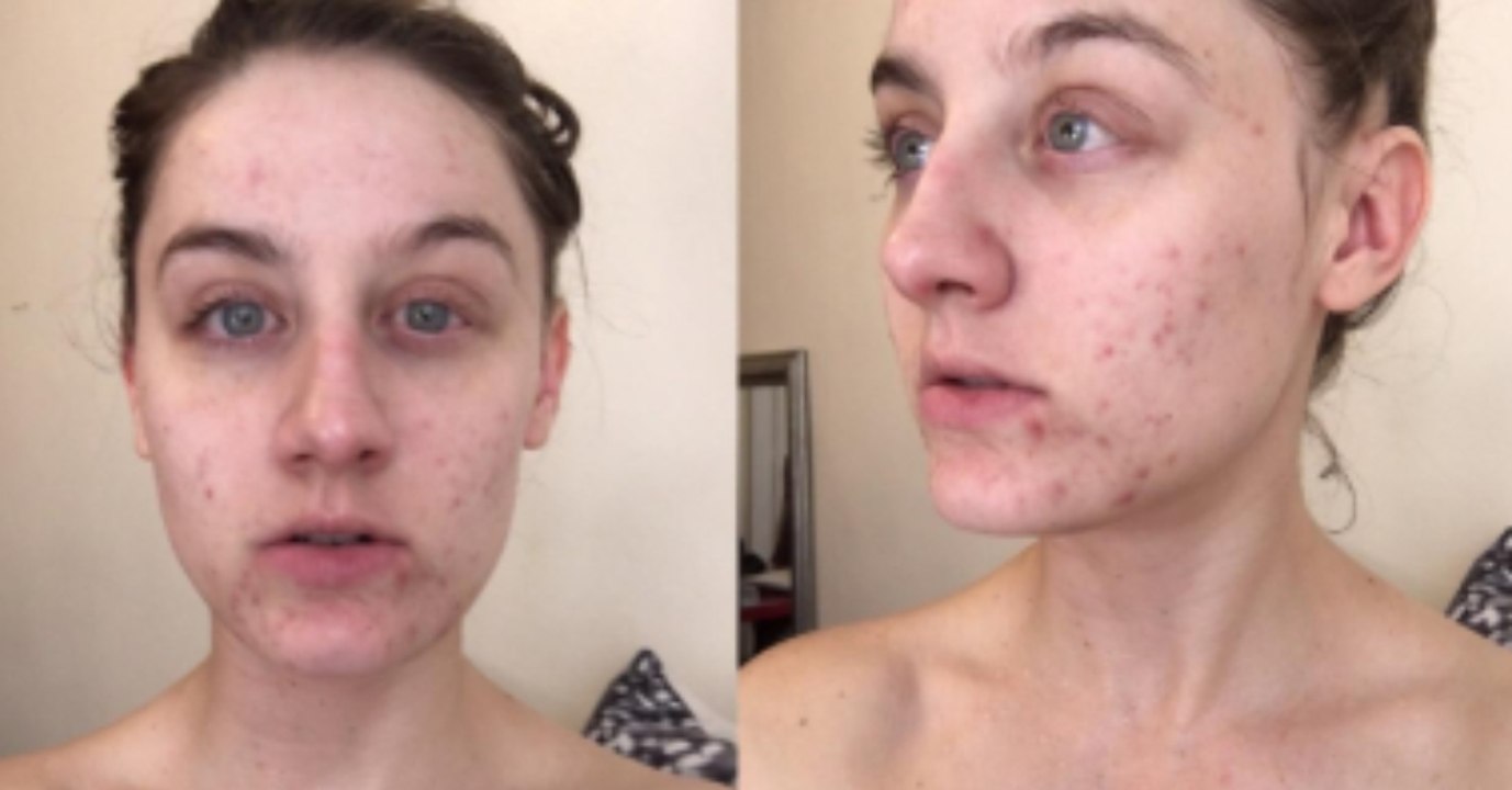 Mit einem genialen Trick wird die Frau ihre Akne im Handumdrehen los!
