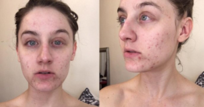 Mit einem genialen Trick wird die Frau ihre Akne im Handumdrehen los!