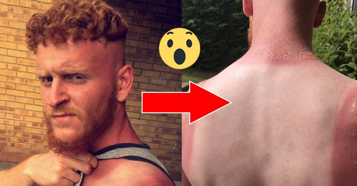 Er hat einen Horror-Sonnenbrand am Arm! Diese Bilder sollten uns eine Lektion sein!