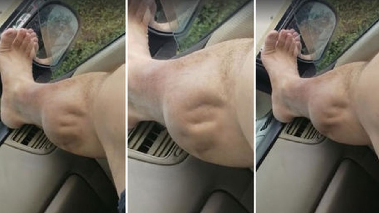 Dieser Sportler hat den heftigsten Krampf der Welt! Unglaublich, wie der Muskel 'tanzt'!