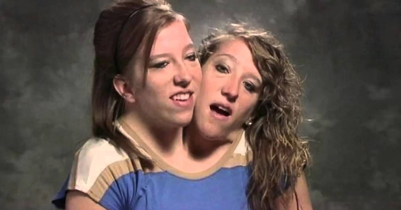 Siamesische Zwillinge: Nach langem Kampf ist ihr Traum endlich wahr geworden