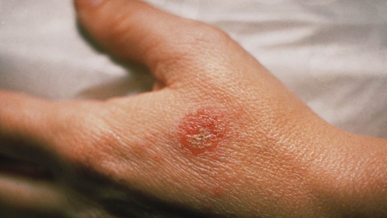 Ekzem: Ursache und Behandlung der Symptome