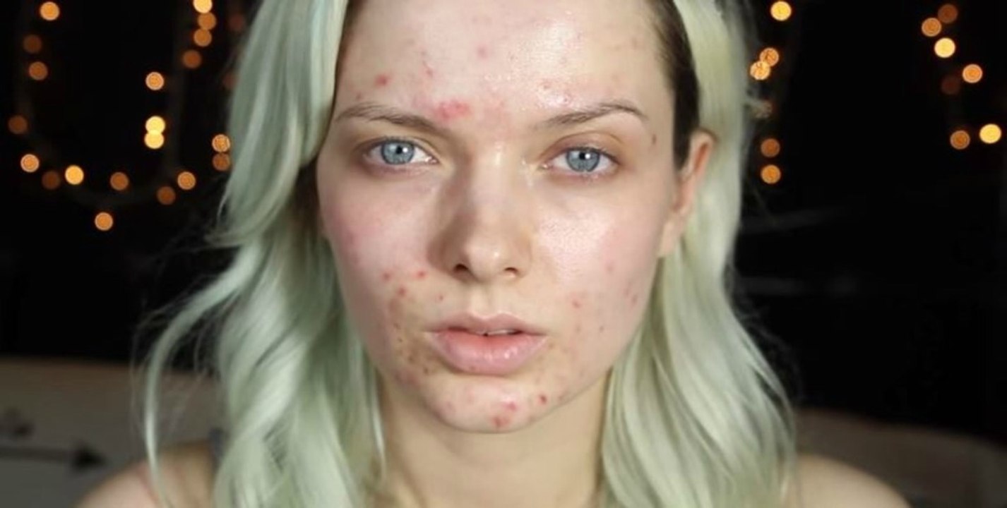 Instagram-trend: akne posten