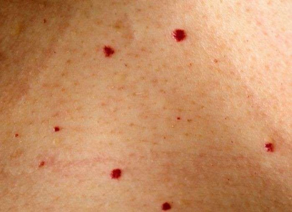 Hast du rote Pünktchen auf der Haut? Wir sagen dir, was das ist.