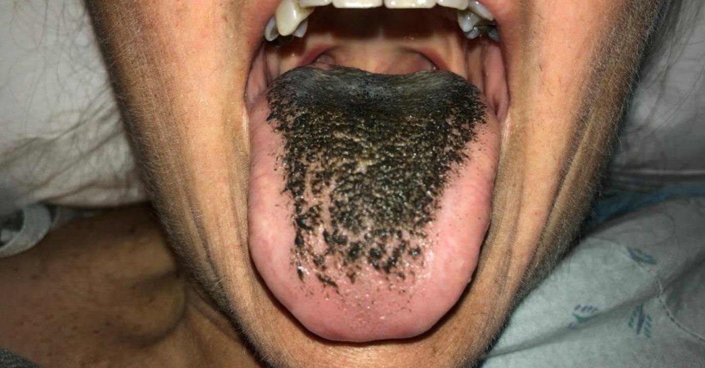 Haare auf der Zunge: Harmloses Medikament mit bösen Nebenwirkungen