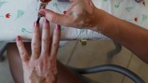Streifen auf dem Nagel: Frau sieht darin sofort Anzeichen für eine schlimme Krankheit