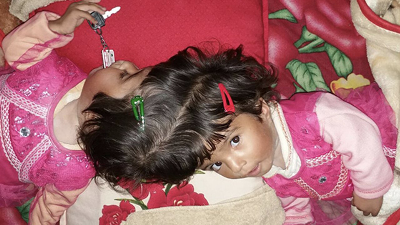 Chirurgische Meisterleistung: Ärzte trennen erneut siamesische Zwillinge