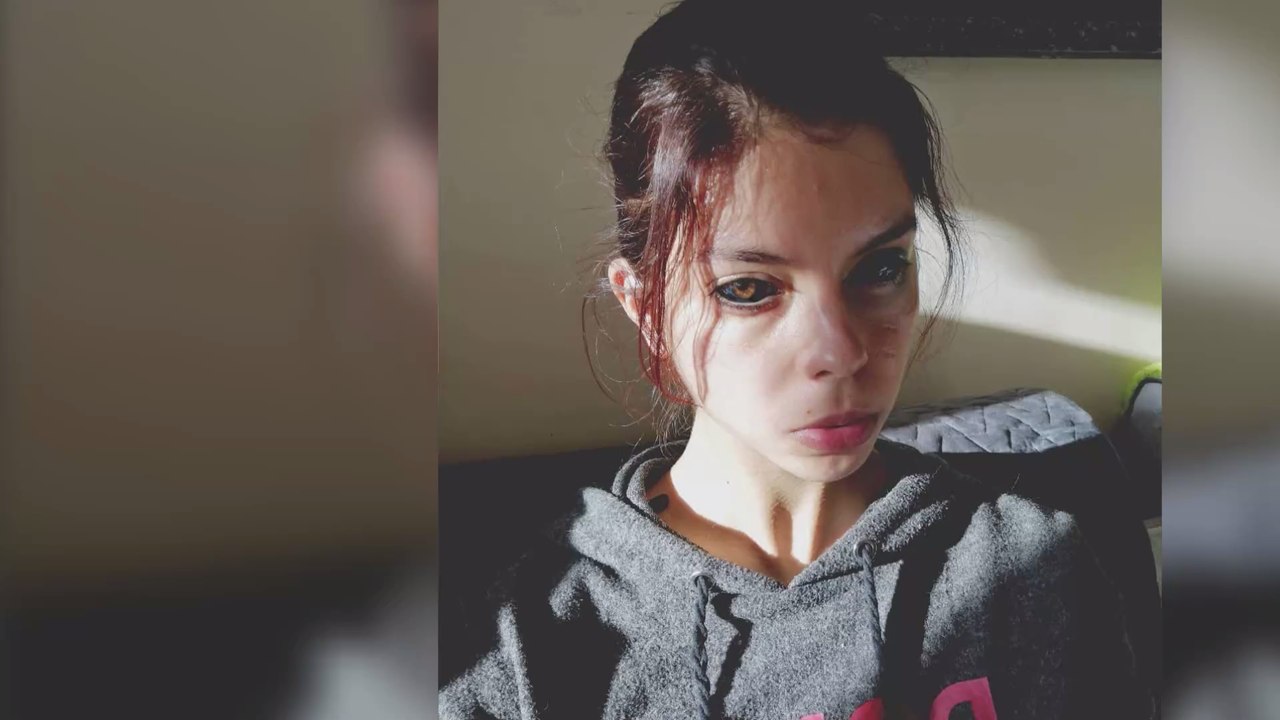 Nach Augen-Tattoo: Polnische Influencerin erblindet