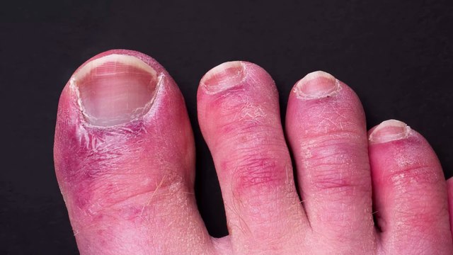 Von wegen Corona-Zehen : Auch die Corona-Impfung kann die Farbe unserer Zehen und Finger verändern