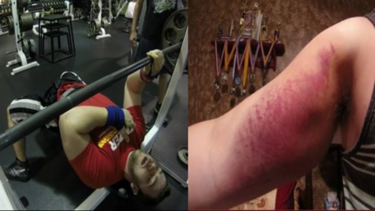 Eine unfassbare Verletzung beim Bankdrücken