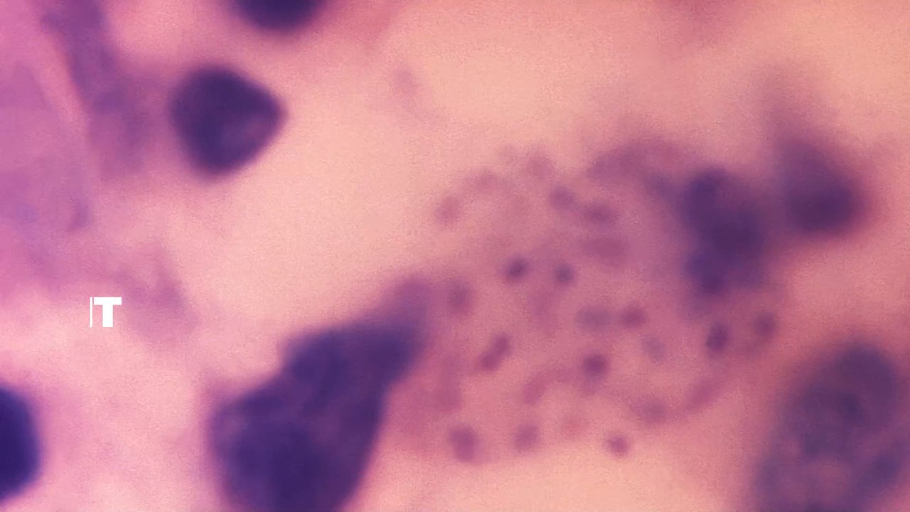 Britische Mediziner:innen warnen: 'Fleischfressende' Geschlechtskrankheit dringt nach Europa vor