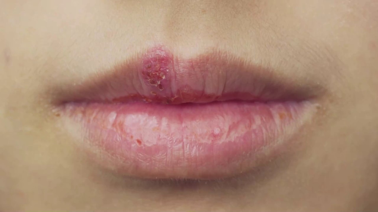 Lippenherpes: Dieser Beautytrend fördert die Entstehung der fiesen Pusteln