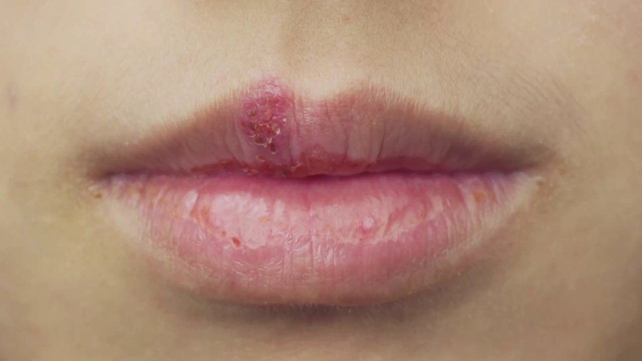Herpes simplex: Befindet sich das Bläschen in der Nase, kann es zu einer Hirnentzündung führen