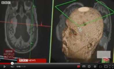 Vidéo : un homme dans un état végétatif réussit à "parler" à ses médecins