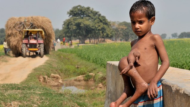 Qu'est-ce qu'un jumeau parasite ?