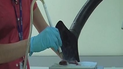 Cancer : un bistouri "intelligent" capable de distinguer les tissus sains des tumeurs