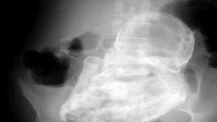 Un foetus mort depuis 40 ans découvert dans le ventre d'une Colombienne