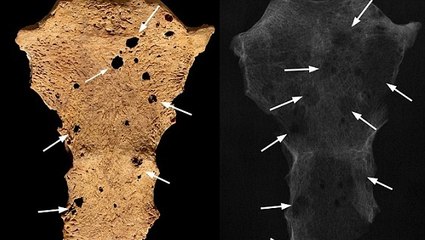 Un cancer vieux de 3200 ans découvert sur un squelette au Soudan