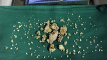 Un médecin retire 232 dents de la bouche d'un adolescent indien
