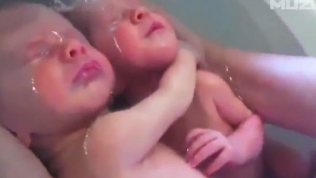 Diese Zwillinge wollen nach der Geburt nicht getrennt werden