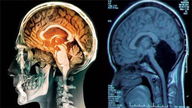 A 24 ans, une Chinoise découvre qu'il lui manque un morceau de cerveau