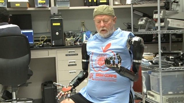 Amputé des deux bras, il réussit à faire bouger ses deux prothèses par la pensée
