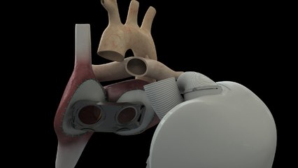 Coeur artificiel Carmat : le deuxième patient greffé est mort