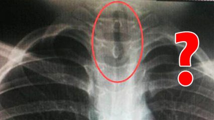 Des médecins chinois font une effrayante découverte dans la gorge d'un patient