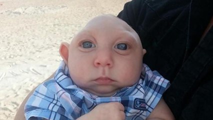 Jaxon, le bébé atteint d’une rare malformation célèbre son premier anniversaire