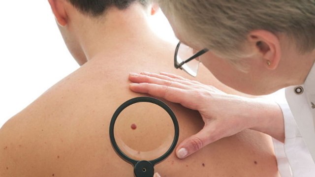 Mélanome : le nombre de grains de beauté sur le bras révèlerait le risque de cancer