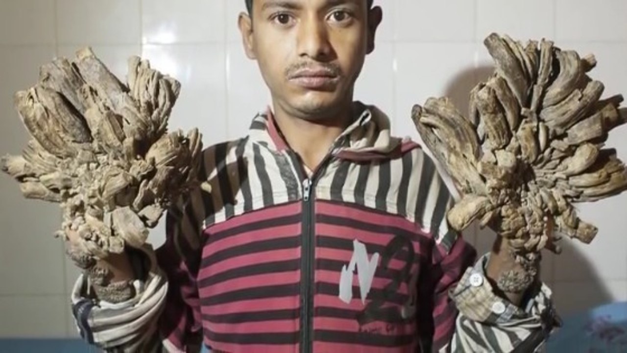 Abul Bajandar, "l'homme-arbre" venu du Bangladesh va bientôt se faire opérer