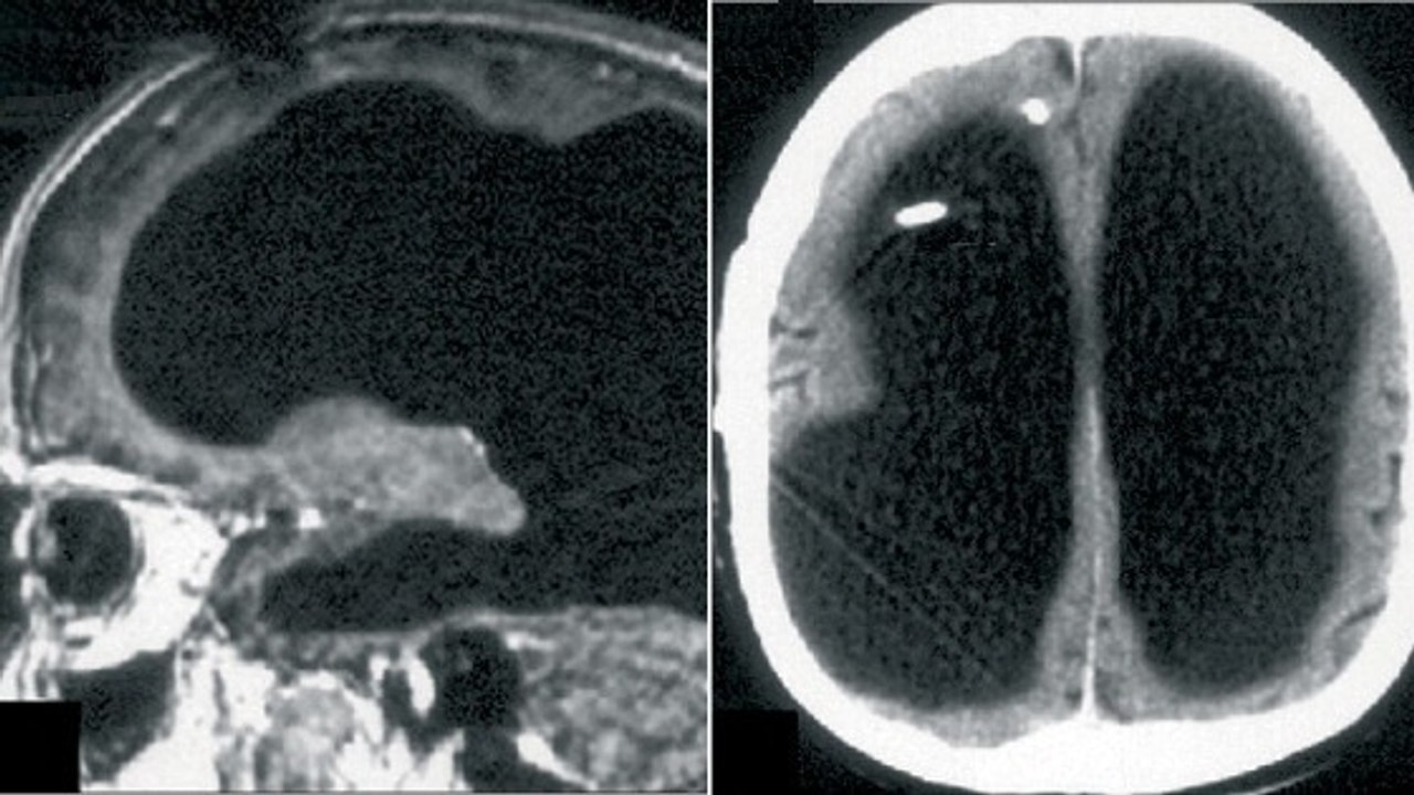 L'étrange cas de cet homme qui a perdu 90% de son cerveau mais qui se porte bien