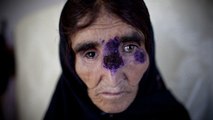 „Der Teufel von Aleppo“: Diese schlimme Krankheit wütet in Syrien